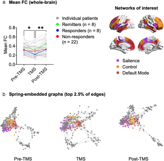 Acute perturbations of whole-brain and triple-network connectivity during Low-Frequency-Right TMS for Treatment Resistant Depression